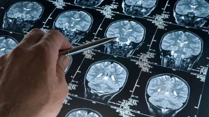 ABD'de bir ilk: Alzheimer ilacına tam onay çıktı!