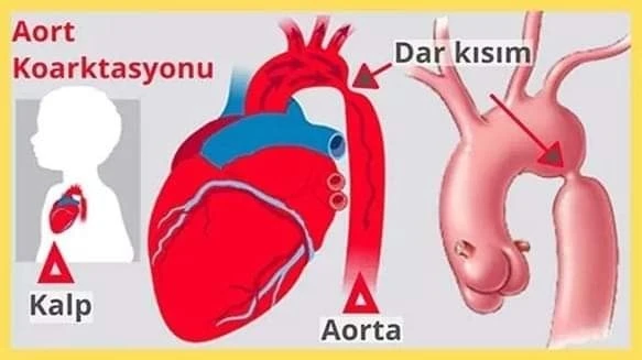 Bandırma’da ilk kez aort koarktasyon ameliyatı yapıldı
