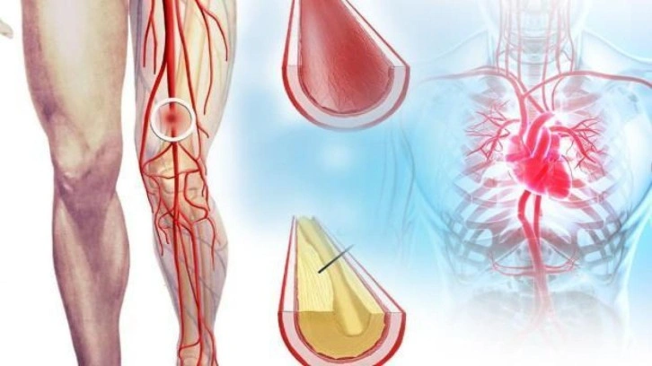 Damar tıkanıklığı hangi hastalıkla neden olur? Bacak damar tıkanıklığı belirtileri nelerdir?