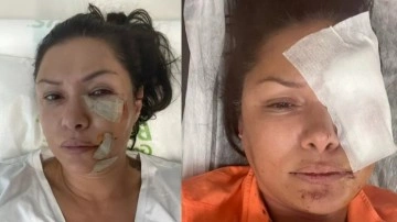 Şarkıcı Tuğba Altıntop köpek saldırısına uğradı! Yüzüne dikiş atıldı